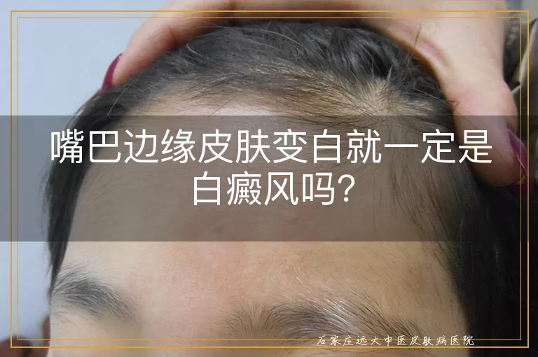 嘴巴边缘皮肤变白就一定是白癜风吗？