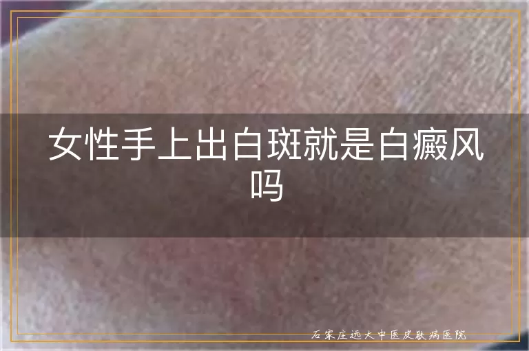 女性手上出白斑就是白癜风吗