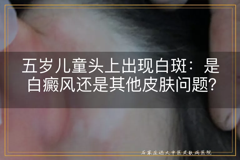 五岁儿童头上出现白斑：是白癜风还是其他皮肤问题？