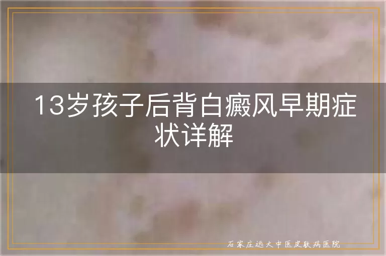 13岁孩子后背白癜风早期症状详解