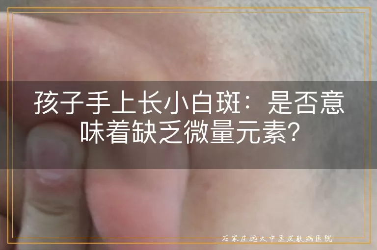 孩子手上长小白斑：是否意味着缺乏微量元素？