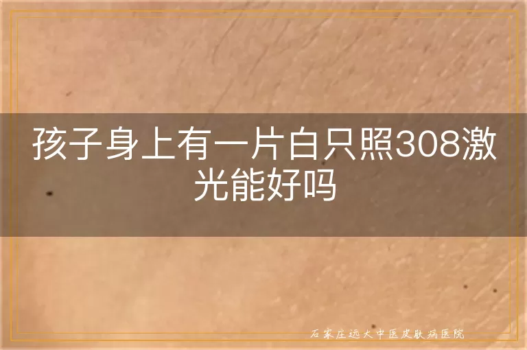 孩子身上有一片白只照308激光能好吗