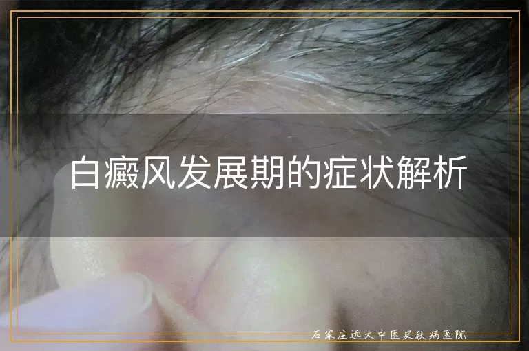 白癜风发展期的症状解析