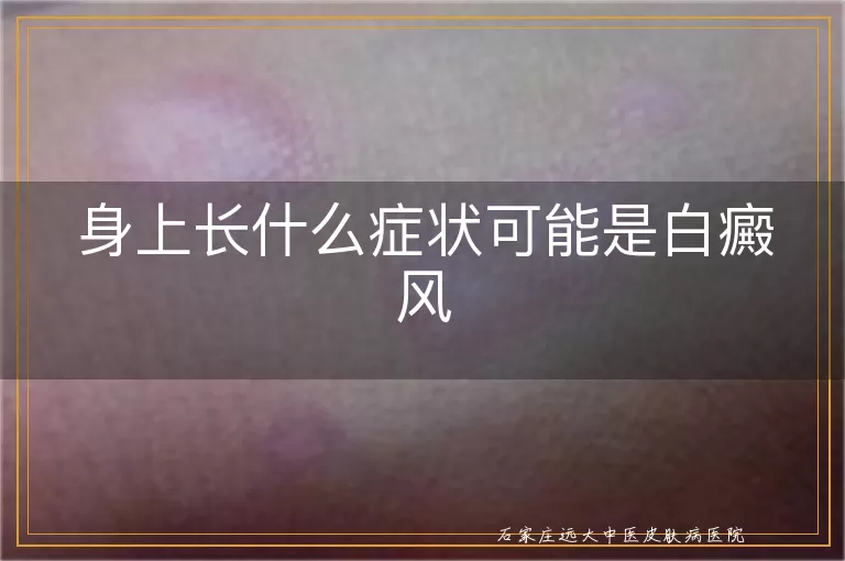 身上长什么症状可能是白癜风