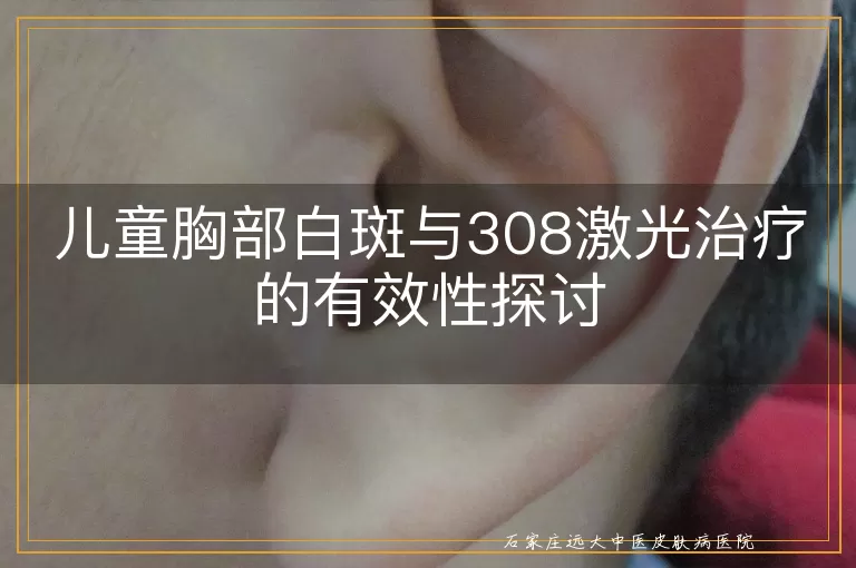 儿童胸部白斑与308激光治疗的有效性探讨