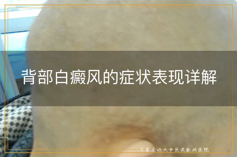 背部白癜风的症状表现详解
