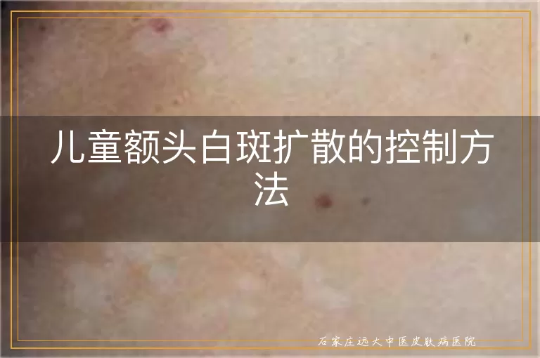 儿童额头白斑扩散的控制方法