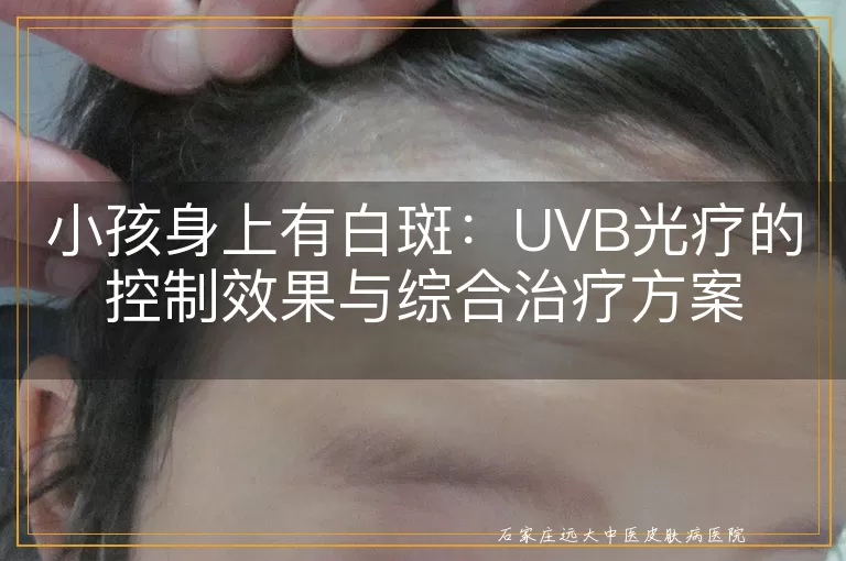 小孩身上有白斑：UVB光疗的控制效果与综合治疗方案