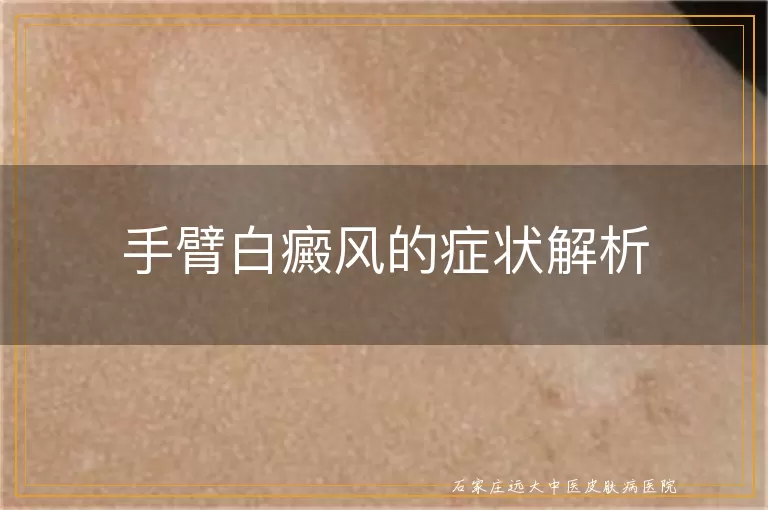 手臂白癜风的症状解析