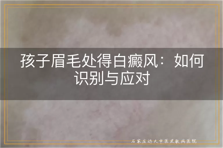 孩子眉毛处得白癜风：如何识别与应对
