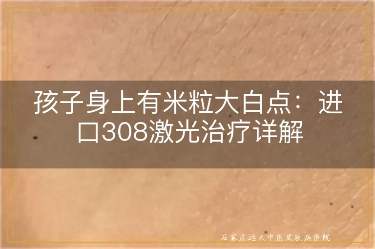 孩子身上有米粒大白点：进口308激光治疗详解