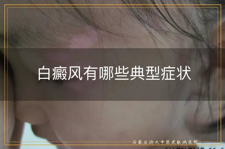 白癜风有哪些典型症状