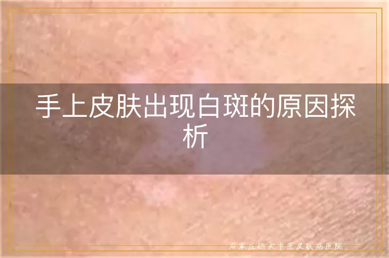 手上皮肤出现白斑的原因探析