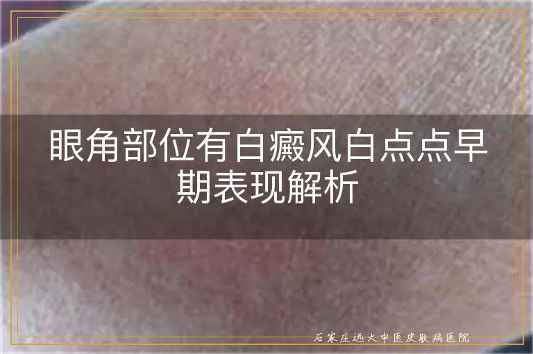 眼角部位有白癜风白点点早期表现解析