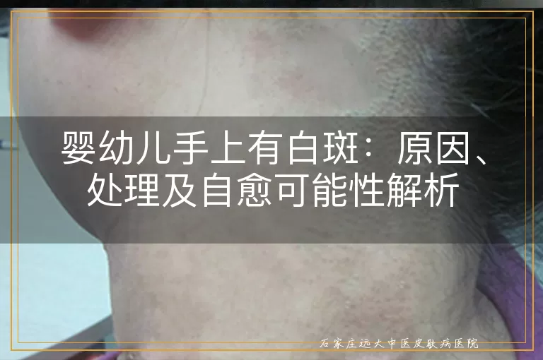婴幼儿手上有白斑：原因、处理及自愈可能性解析