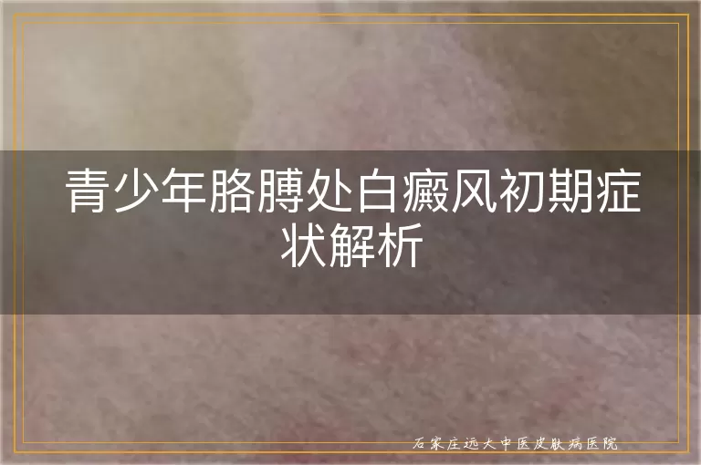 青少年胳膊处白癜风初期症状解析