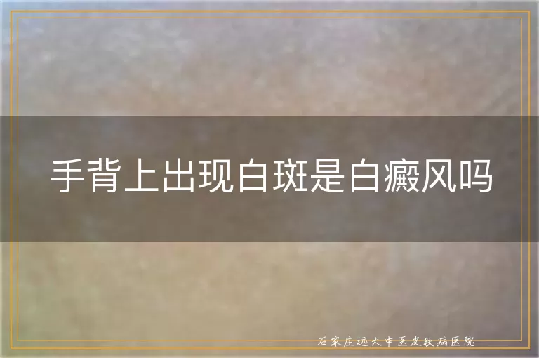 手背上出现白斑是白癜风吗