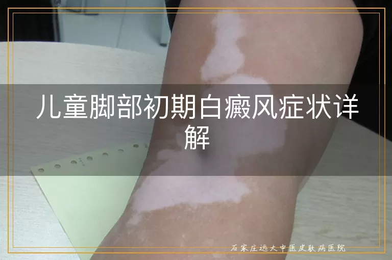 儿童脚部初期白癜风症状详解