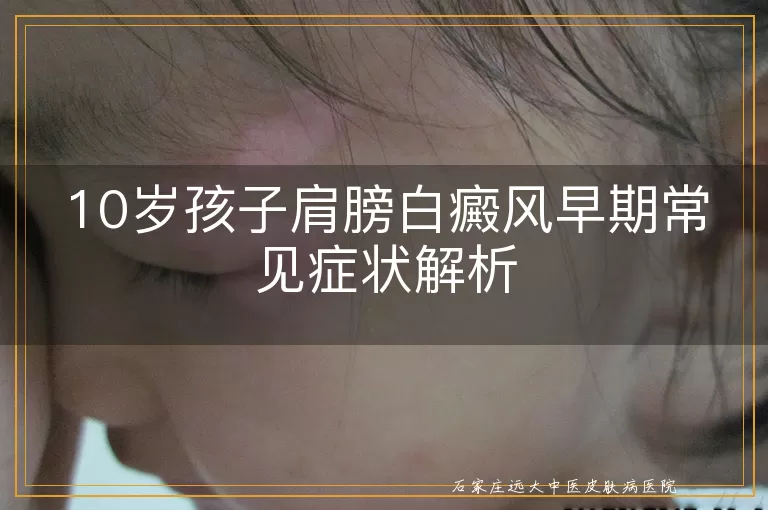 10岁孩子肩膀白癜风早期常见症状解析