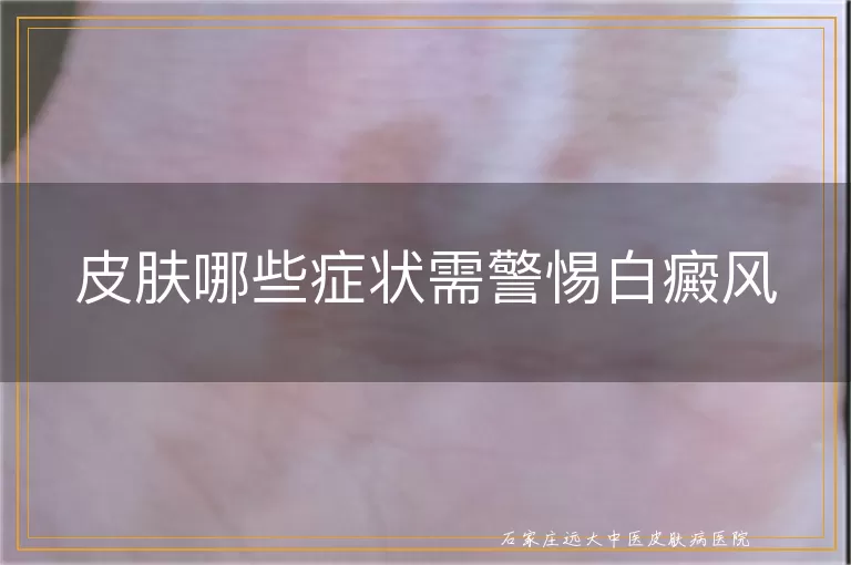 皮肤哪些症状需警惕白癜风