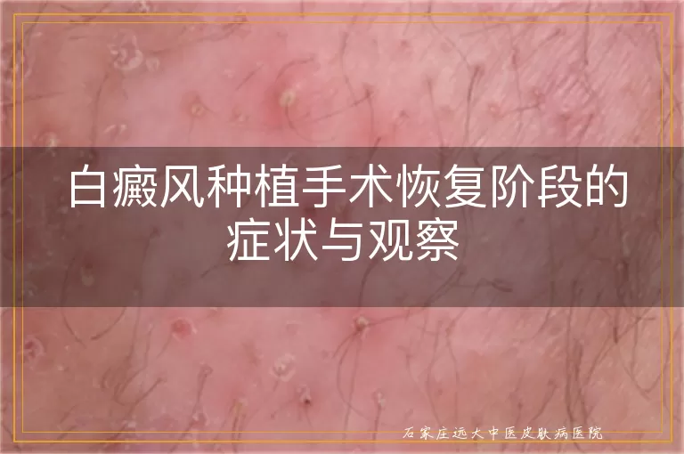 白癜风种植手术恢复阶段的症状与观察