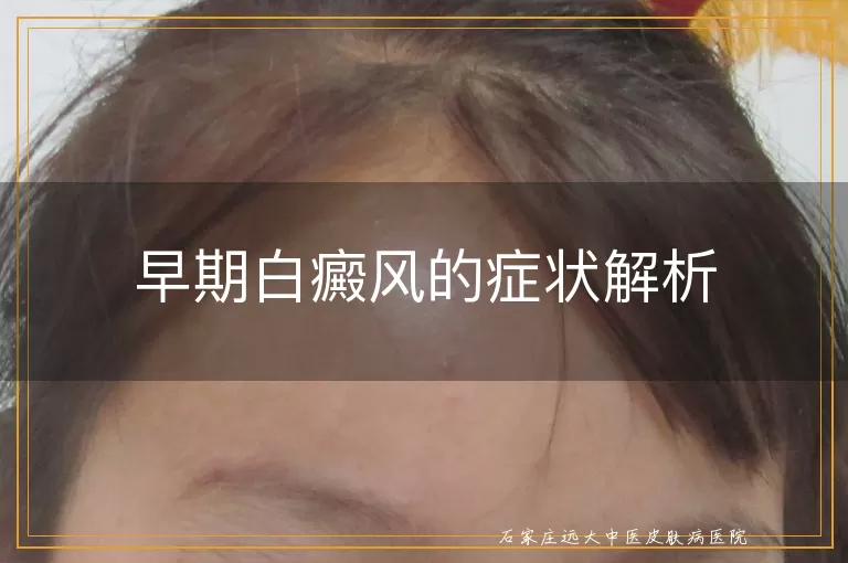 早期白癜风的症状解析