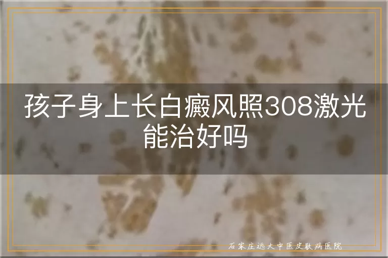 孩子身上长白癜风照308激光能治好吗