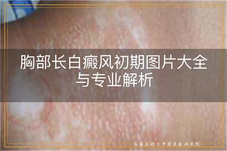 胸部长白癜风初期图片大全与专业解析