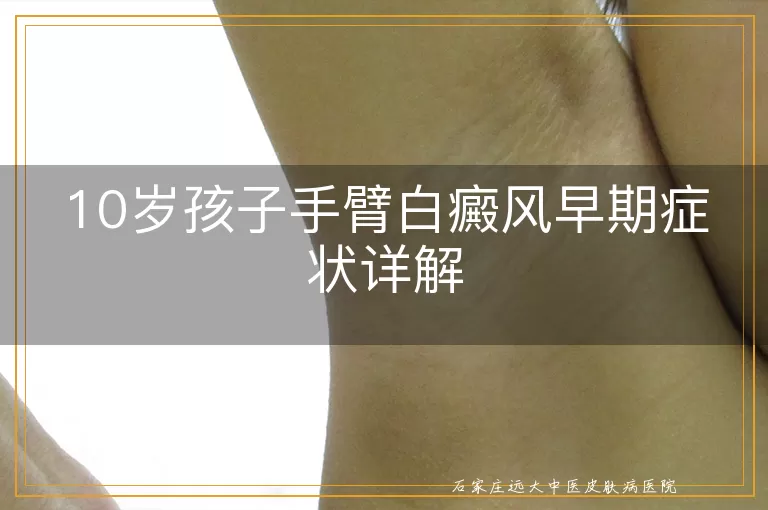 10岁孩子手臂白癜风早期症状详解