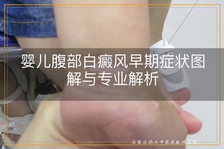 婴儿腹部白癜风早期症状图解与专业解析