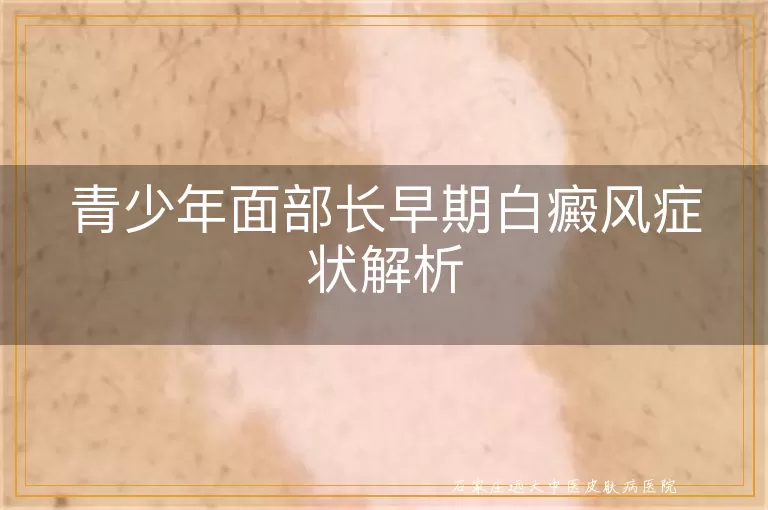 青少年面部长早期白癜风症状解析