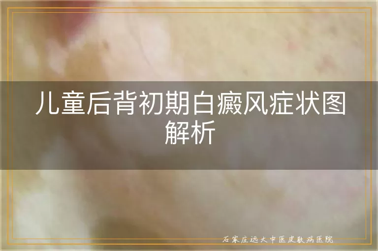 儿童后背初期白癜风症状图解析