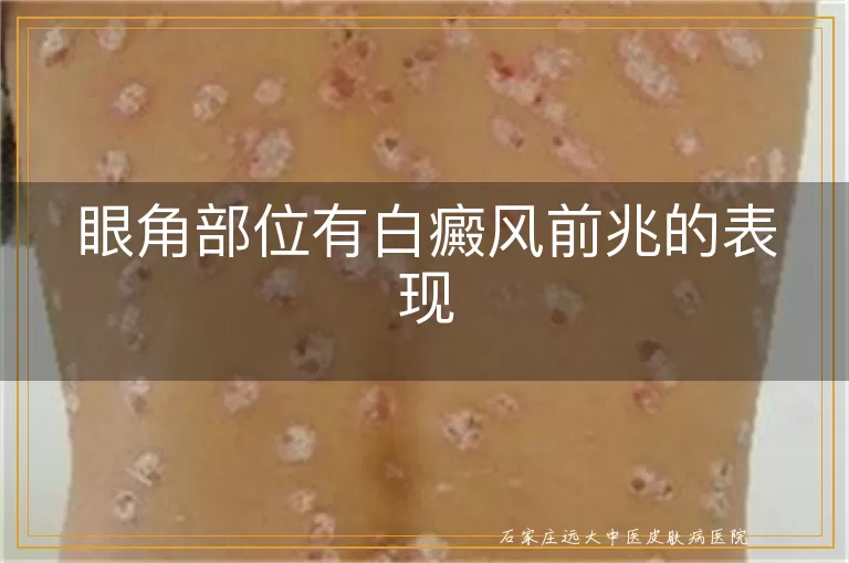 眼角部位有白癜风前兆的表现