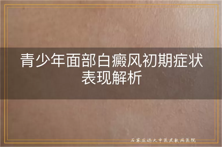 青少年面部白癜风初期症状表现解析