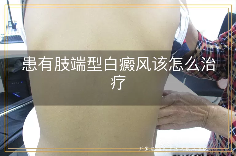 患有肢端型白癜风该怎么治疗