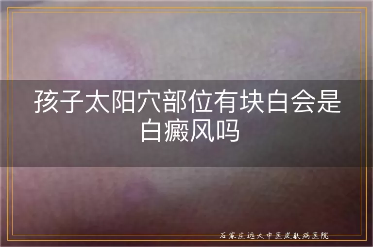 孩子太阳穴部位有块白会是白癜风吗