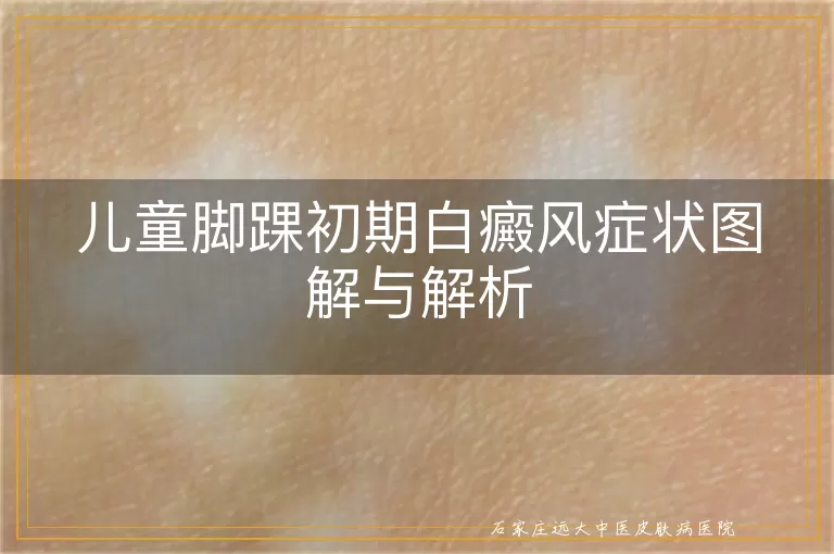 儿童脚踝初期白癜风症状图解与解析