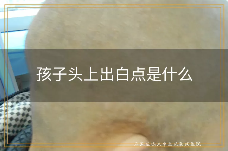 孩子头上出白点是什么