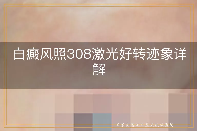 白癜风照308激光好转迹象详解