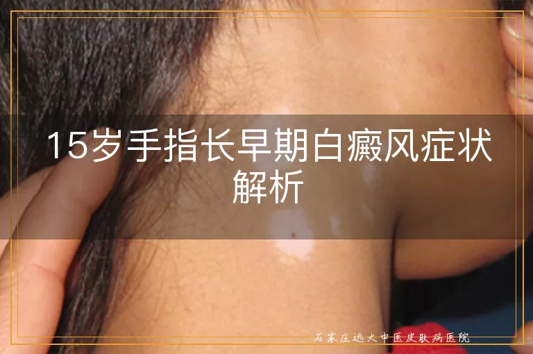 15岁手指长早期白癜风症状解析