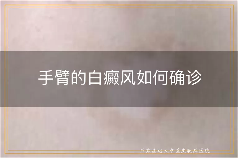 手臂的白癜风如何确诊