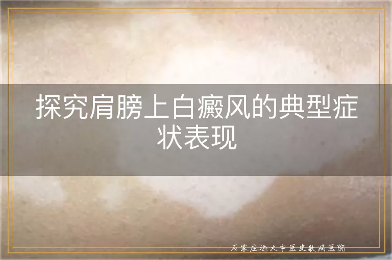 探究肩膀上白癜风的典型症状表现