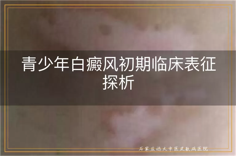 青少年白癜风初期临床表征探析