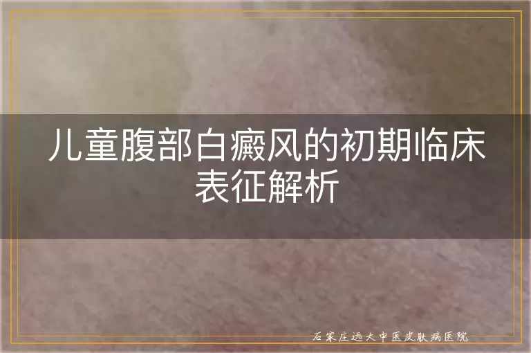 儿童腹部白癜风的初期临床表征解析