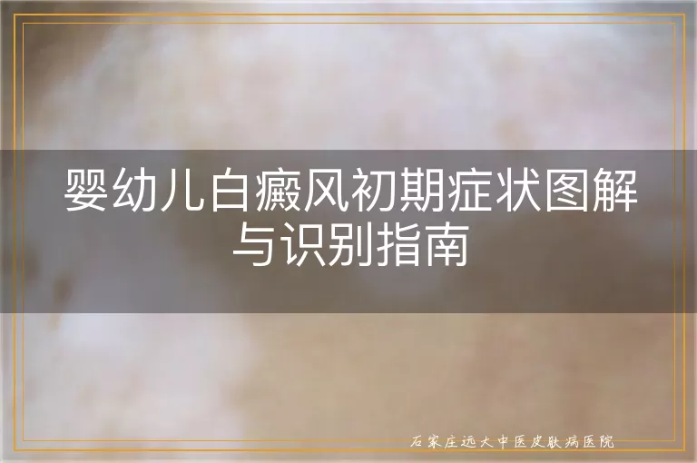 婴幼儿白癜风初期症状图解与识别指南