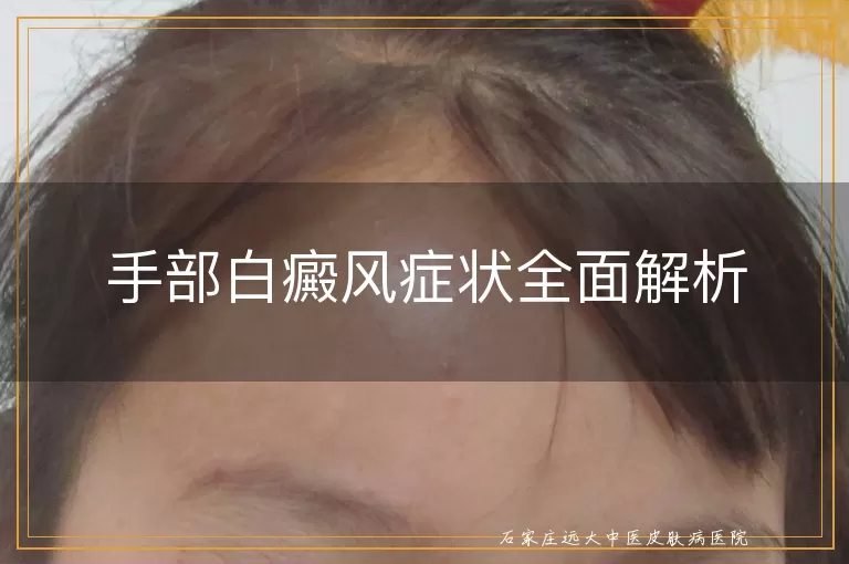 手部白癜风症状全面解析