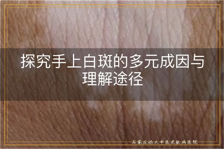 探究手上白斑的多元成因与理解途径