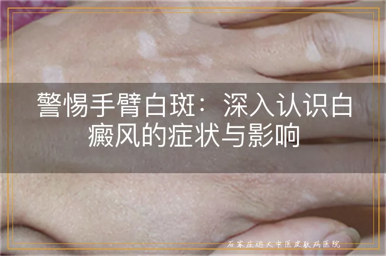 警惕手臂白斑：深入认识白癜风的症状与影响