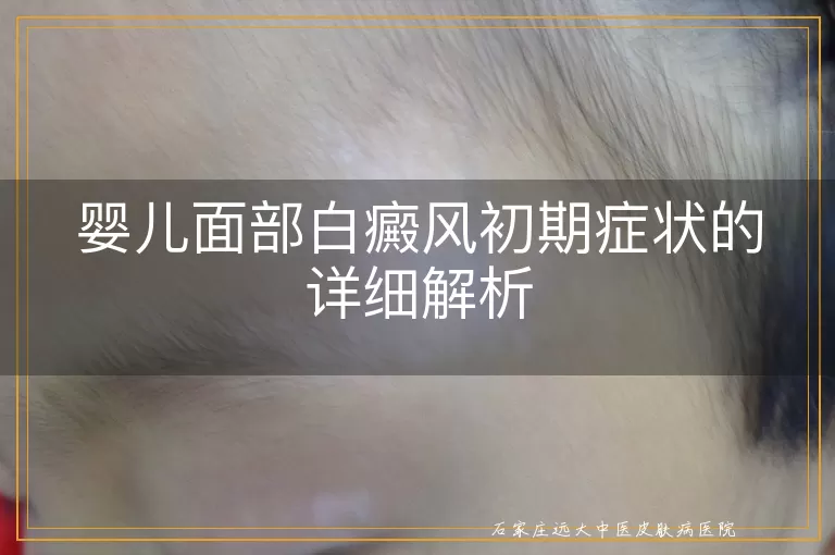婴儿面部白癜风初期症状的详细解析