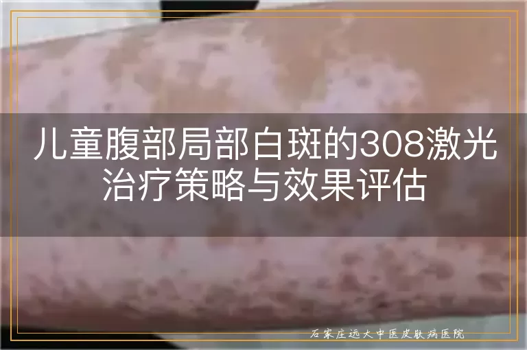 儿童腹部局部白斑的308激光治疗策略与效果评估